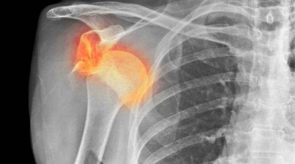 Lussazione della spalla: tempi di recupero ed esercizi | Fisiosocial