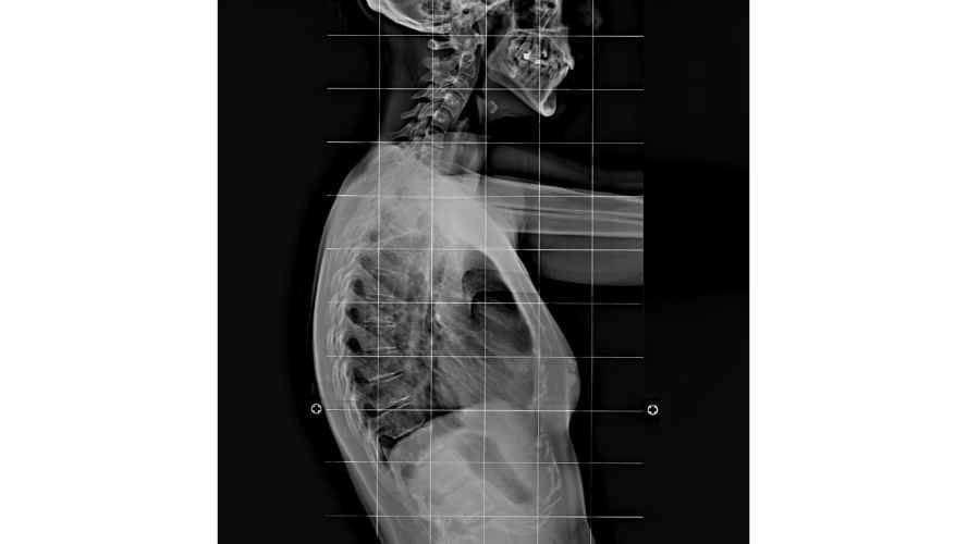 ipercifosi radiografia