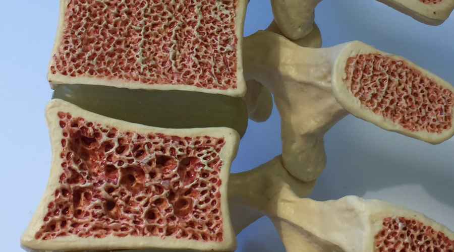 osteoporosi