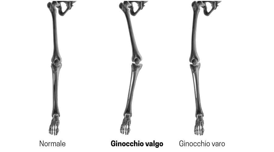 ginocchio valgo