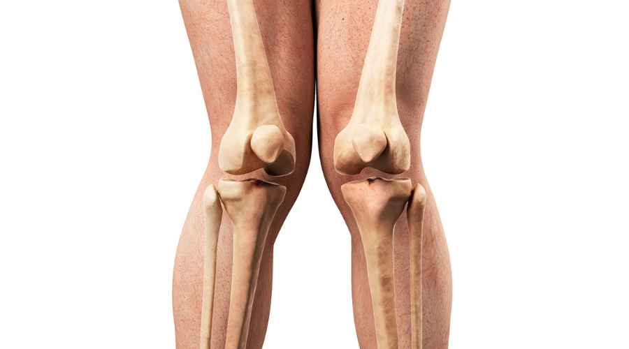 cartilagine ginocchio valgo