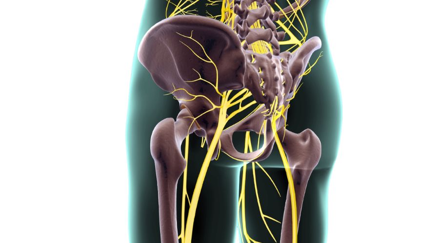 sciatica rimedio