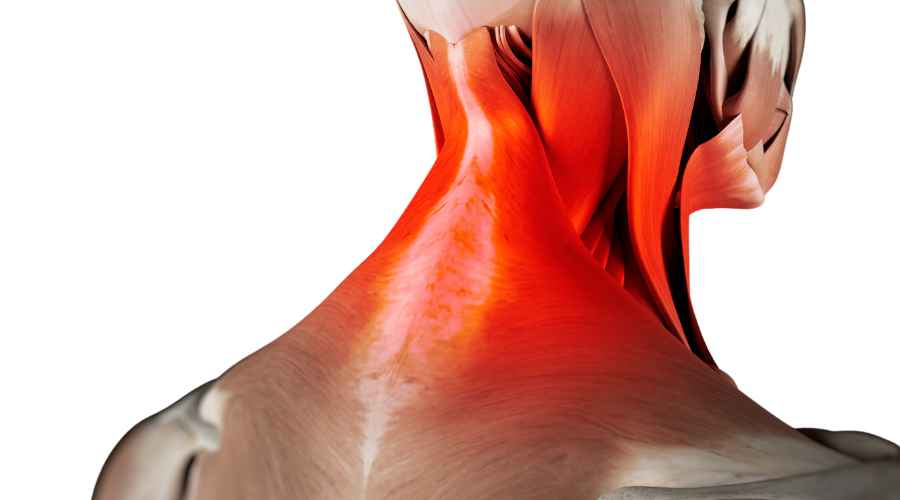 artrosi cervicale muscoli